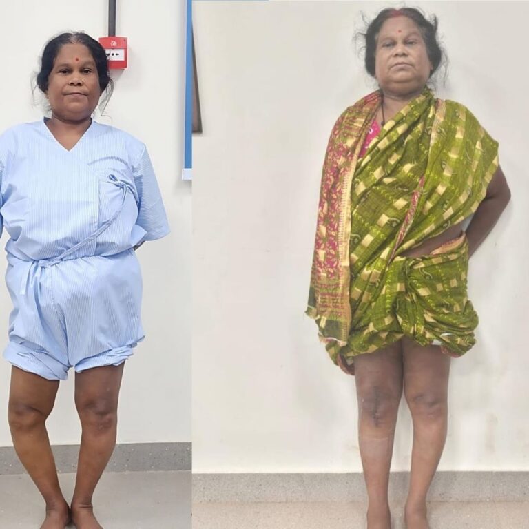 गडचिरोलीत पहिली मोफत गुडघा प्रत्यारोपण शस्त्रक्रिया यशस्वी:असह्य गुडघेदुखीमुळे चालणे-फिरणे कठीण झालेल्या महिलेला दिलासा